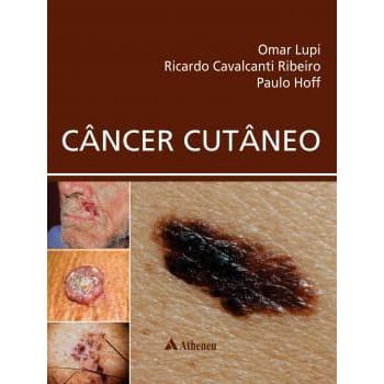 CANCER CUTANEO - Omar Lupi