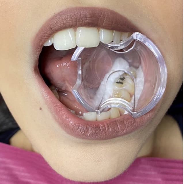 Abridor de boca Lysanda - isolamento relativo