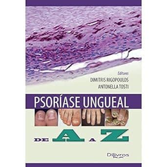 Psoríase Ungueal: De A a Z