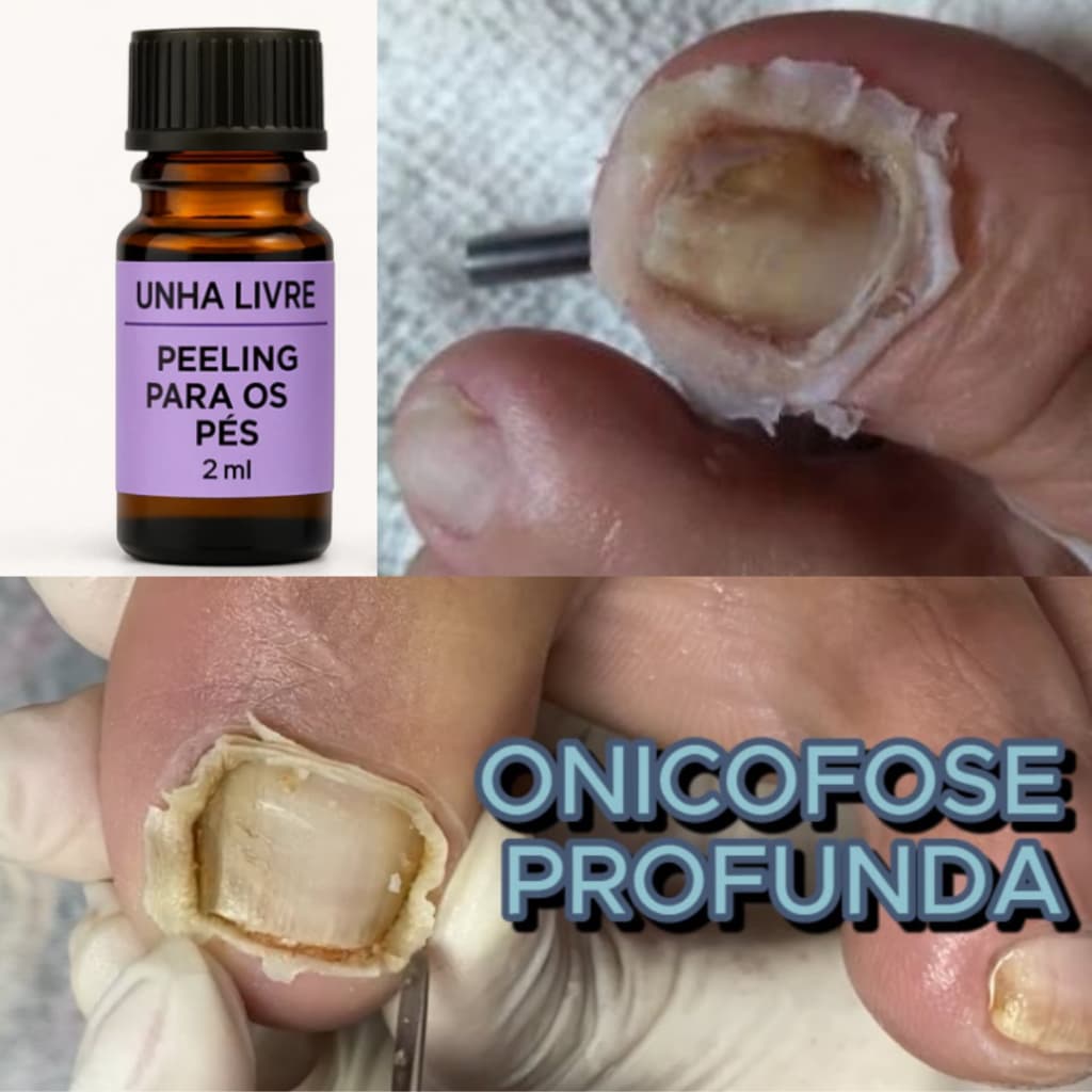 PELLING PARA PODOLOGIA, REMOÇÃO DE ONICOFOSES 2 ML