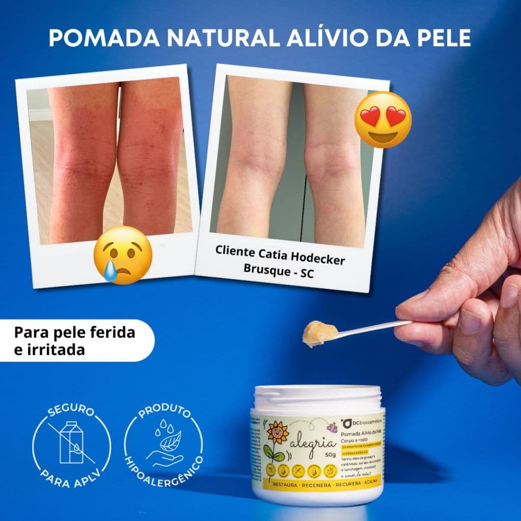 Pomada Alívio da Pele para Coceira, Pele Seca, Dermatite, Psoríase [Dermatite Controlada]