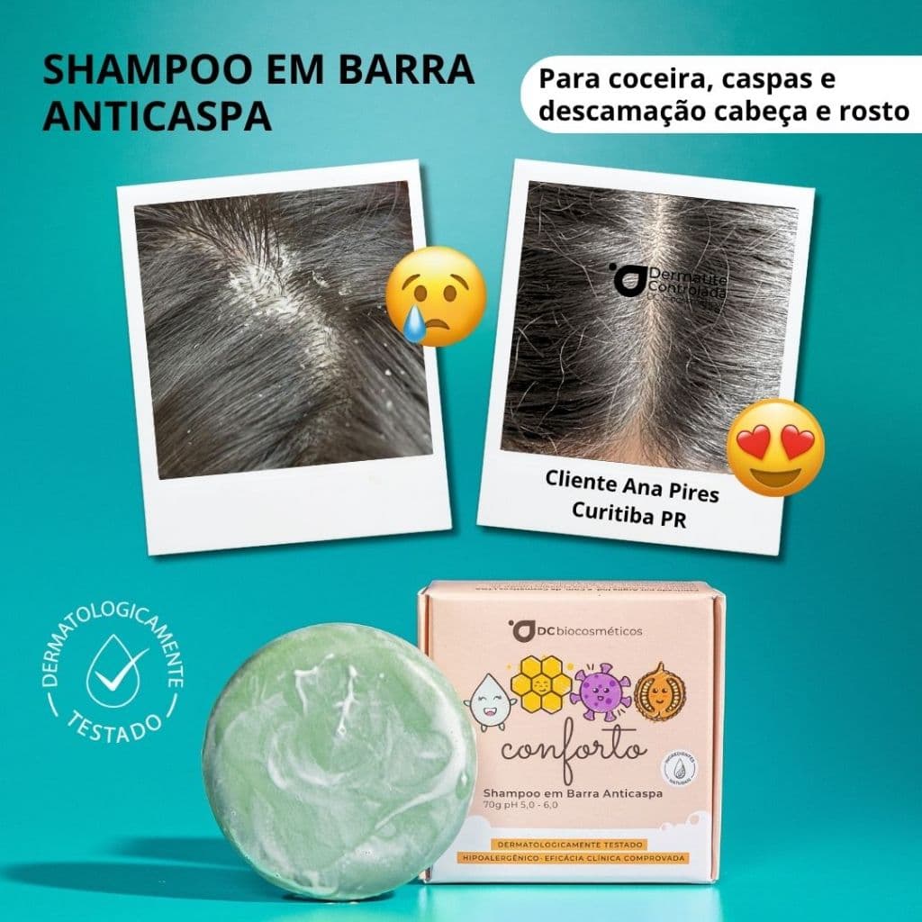 Shampoo Anticaspa Natural em Barra para Dermatite, Psoríase, Eczema