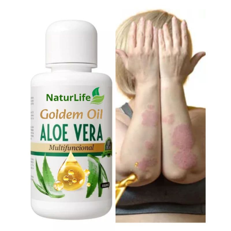 Tratamento Psoríase Óleo de Babosa 100ml - Cure, Hidrate e Proteja Sua Pele