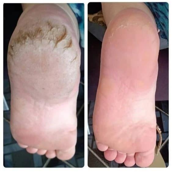 Creme Hidratante do Pedreiro Para Rachaduras Ressecamentos Mãos Pés e Cotovelos Grosso Nutre Amacia Hidrata a Pele