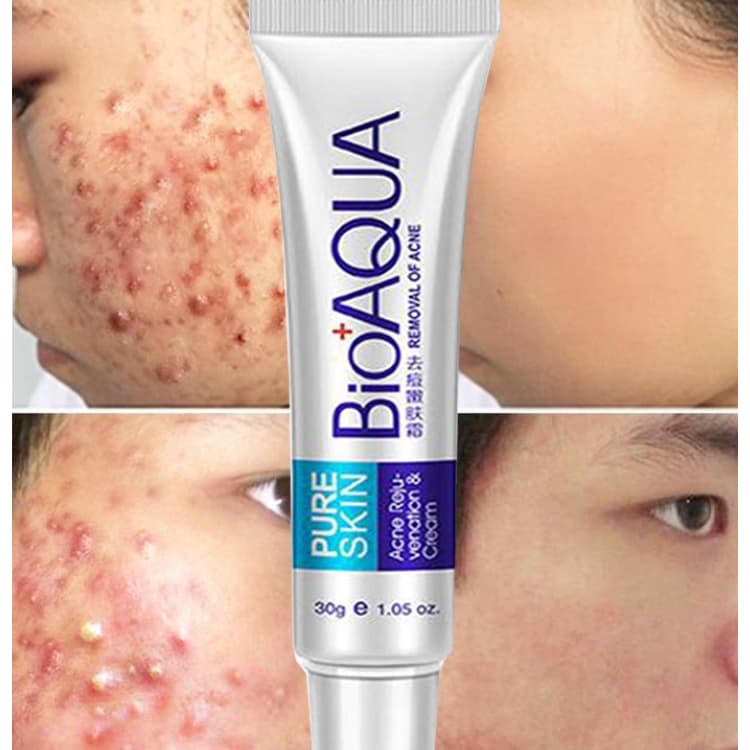Creme Acne Bioaqua Pele Pura 30g Pele Oleosa