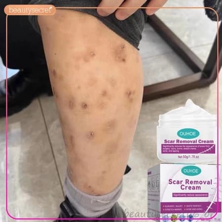 Creme Eliminar Cicatrizes Pretas Remover Feridas Antigas Picada de Mosquito Cicatriz Quelóide Queimaduras Scal -beleza