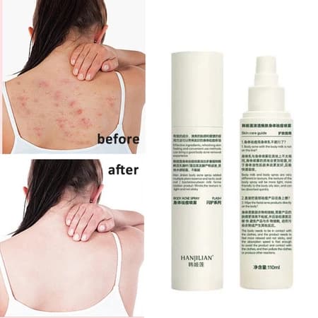 Spray De Tratamento Para Acne Nas Costas-Hidratante , Controle De Oleosidade E Redução De Cicatrizes