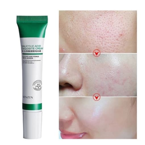 Creme De Ácido Salicílico 20ml Para Remoção E Clareamento De Poros/Acne/Controle De Óleo /