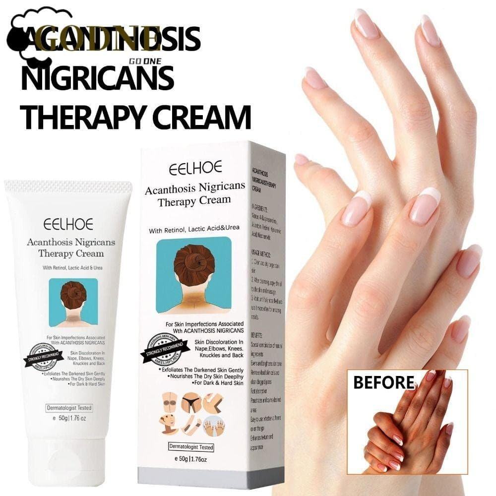 GODNESSFO Acantose Nigricans Therapy Cream 50g Glow White Moist Creme Corretor De Manchas Escuras