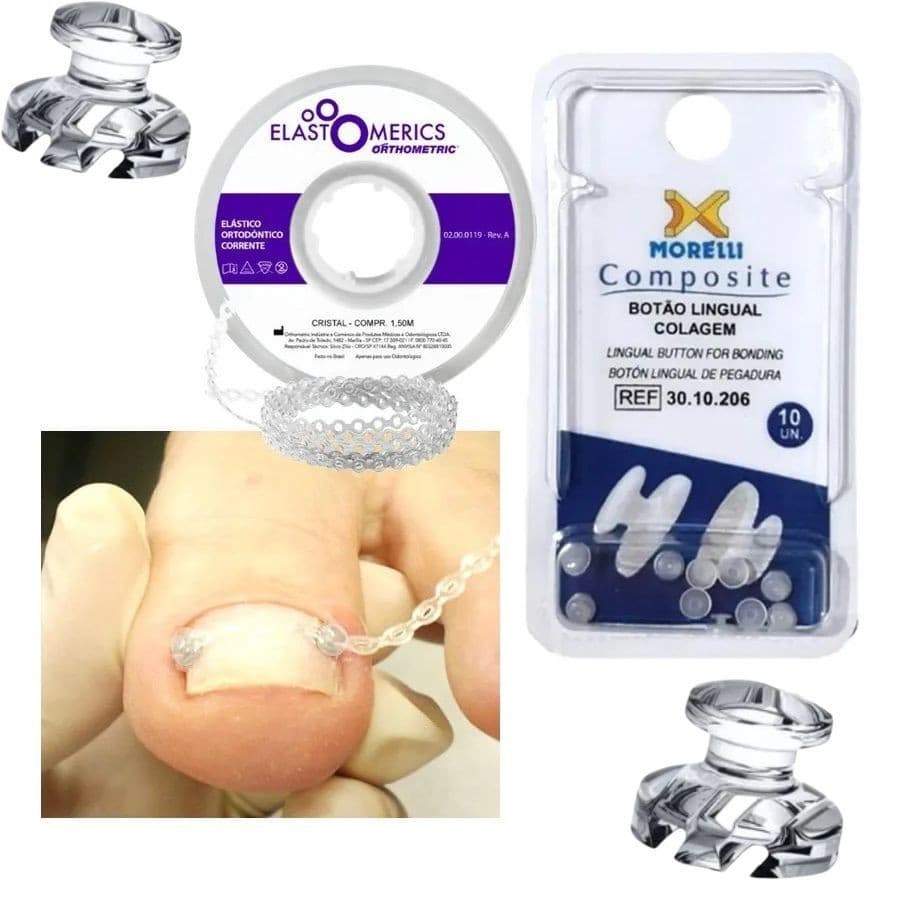 Kit Podologia C/ Botão Estético + Elástico Corrente 1,5 MT Unha Encravada - Correção
