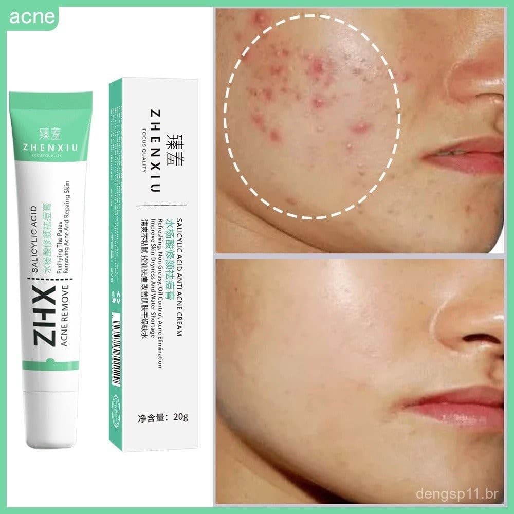 Creme Facial Anti-Acne com Ácido Salicílico para Remover Oleosidade e Cravos, Clareamento de Cicatrizes