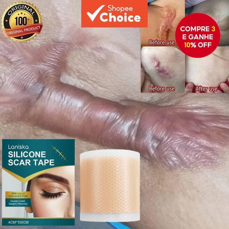 Folhas De Remoção De Cicatriz De Silicone Tratamento De Estrias De Acne Reparação Suavização Cuidados Com A Pele