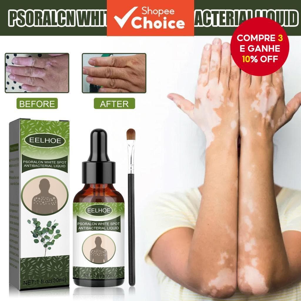  Eelhoe Psoralcn White Spot Antibacteriana Solução Líquida Removedor de Manchas Brancas Vitiligo Essência de Psoraleno -