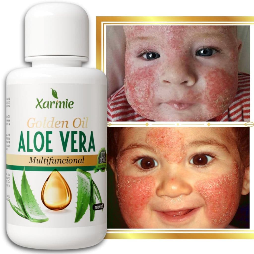 Óleo Aloe Vera para Bebê – Dermatites e Alergias