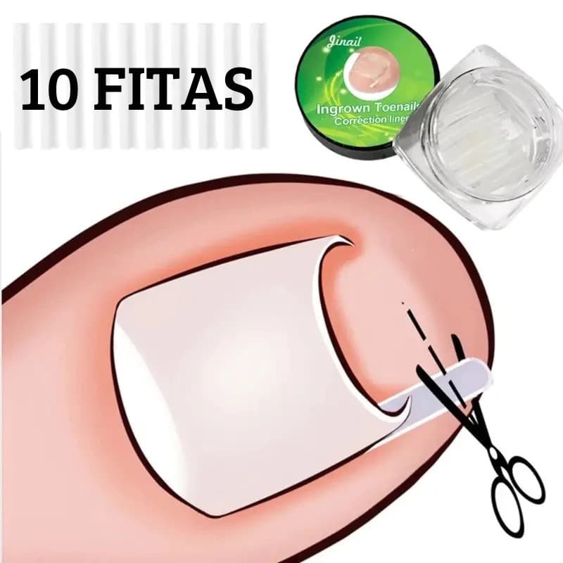 Fita Órtese Desencravar Unha Encravada Corretora 10 Peças