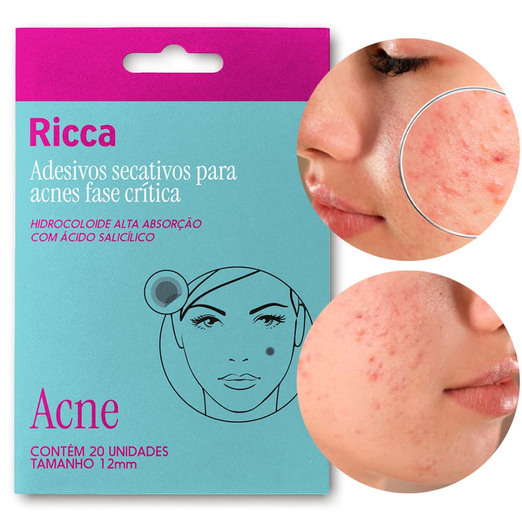 Adesivos Secativos Para Acnes Fase Crítica Com 20un Ricca