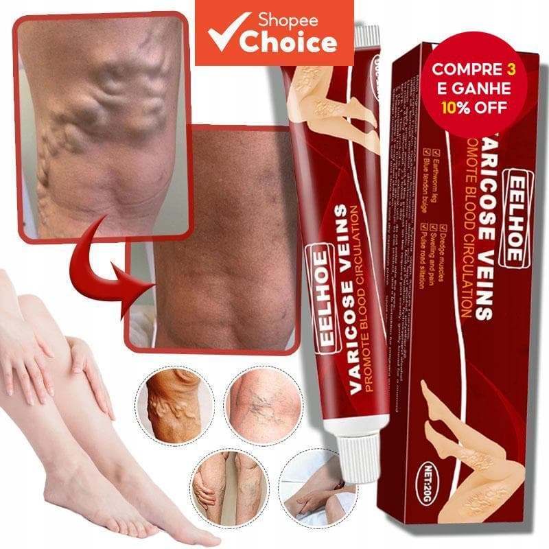  Creme para Varizes, Pomada de Massagem Venosa, Creme para Inflamação de Pernas, Vasculite, Flebite, Pernas de Aranha,