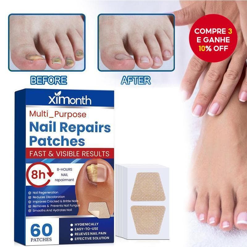 Patches Antifúngicos Para Tratamento De Unhas 60 Unidades Correção E Reparo Encravadas